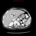Adenocarcinoma of the colon (Radiopaedia 8191-9039 Axial liver window 19).jpg