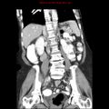 Adenocarcinoma of the colon (Radiopaedia 8191-9039 Coronal liver window 28).jpg