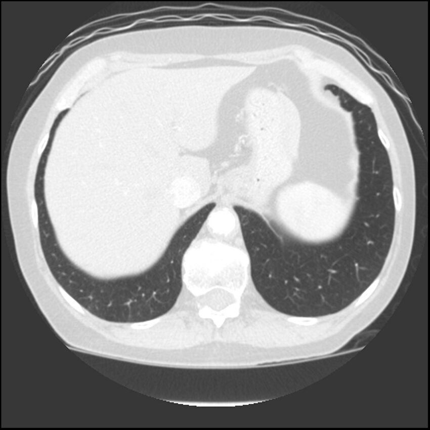 Adenocarcinoma of the lung (Radiopaedia 41015-43755 Axial lung window 109).jpg