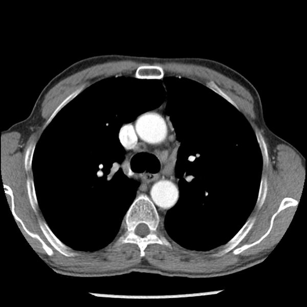 File:Adenocarcinoma of the lung - micropapillary predominant (Radiopaedia 42446-45563 Axial C+ portal venous phase 25).jpg