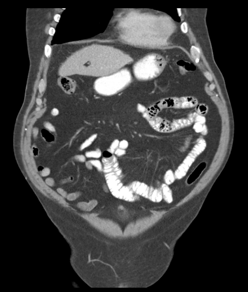 File:Adenocarcioma of rectum- T1 lesion (Radiopaedia 36921-38547 Coronal C+ portal venous phase 18).png