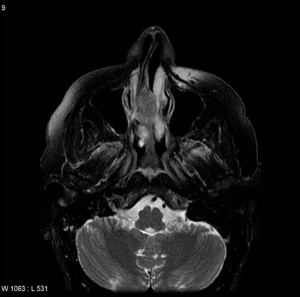 File:Adenoid cystic carcinoma (nasal septum) (Radiopaedia 4547-6668 Axial T2 1).jpg