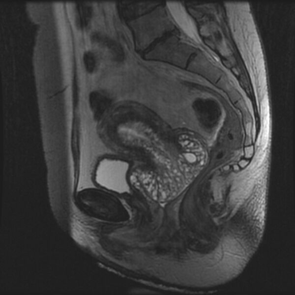 File:Adenoma malignum of the cervix (Radiopaedia 24460-24765 T2 55).jpg