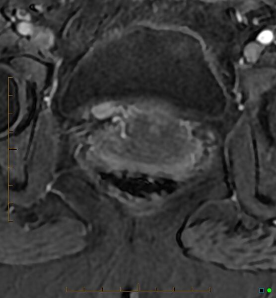 File:Adenomyosis uterus with hematometra (Radiopaedia 45779-50011 Axial T1 C+ fat sat 54).jpg