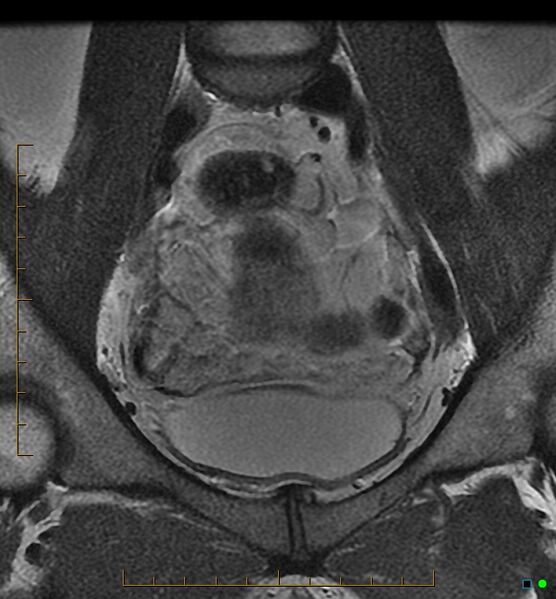 File:Adenomyosis uterus with hematometra (Radiopaedia 45779-50011 Coronal T2 4).jpg