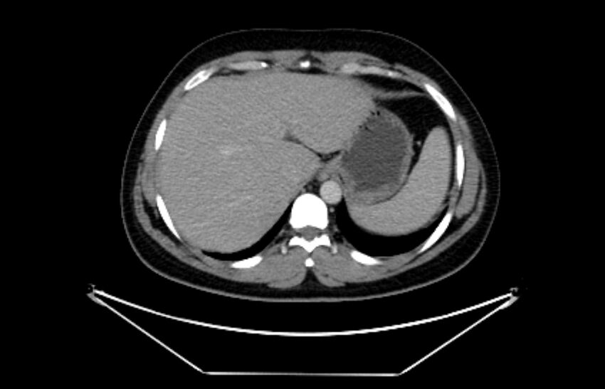 Adrenocortical carcinoma (Radiopaedia 80134-93438 Axial C+ portal venous phase 25).jpg