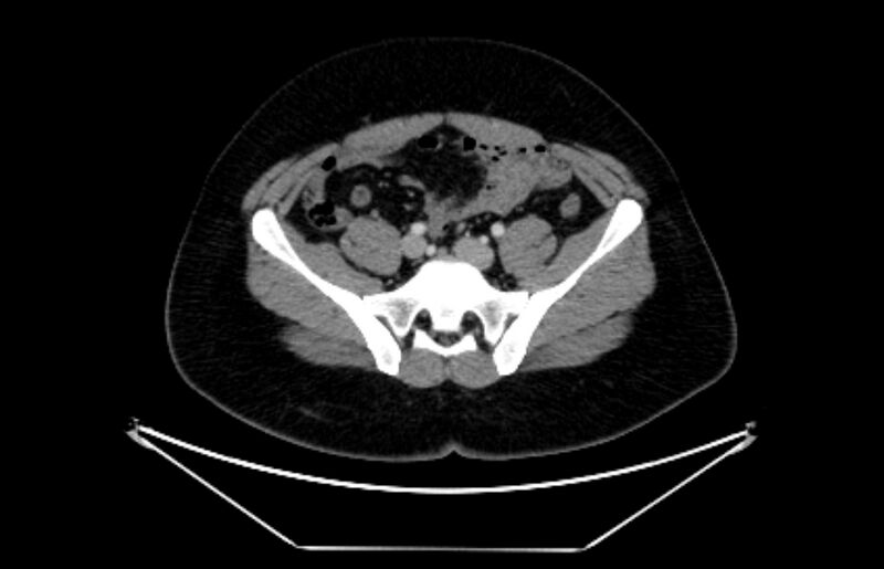 File:Adrenocortical carcinoma (Radiopaedia 80134-93438 Axial C+ portal venous phase 97).jpg