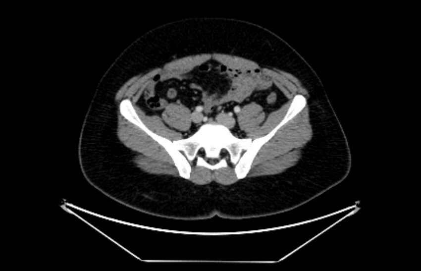 Adrenocortical carcinoma (Radiopaedia 80134-93438 Axial C+ portal venous phase 97).jpg