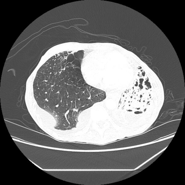 File:Advanced pulmonary tuberculosis (Radiopaedia 8599-9431 Axial lung window 39).jpg