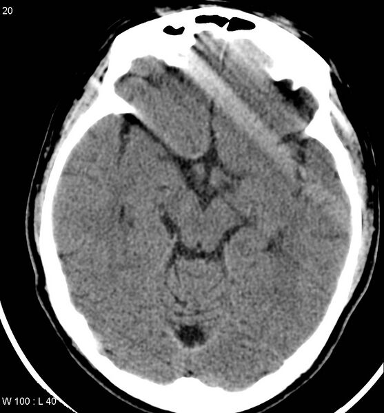 File:Aicardi syndrome (Radiopaedia 5353-7116 Axial non-contrast 17).jpg