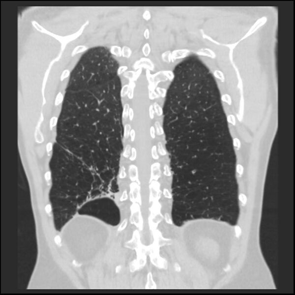 File:Alpha-1-antitrypsin deficiency (Radiopaedia 40993-43722 Coronal lung window 87).jpg
