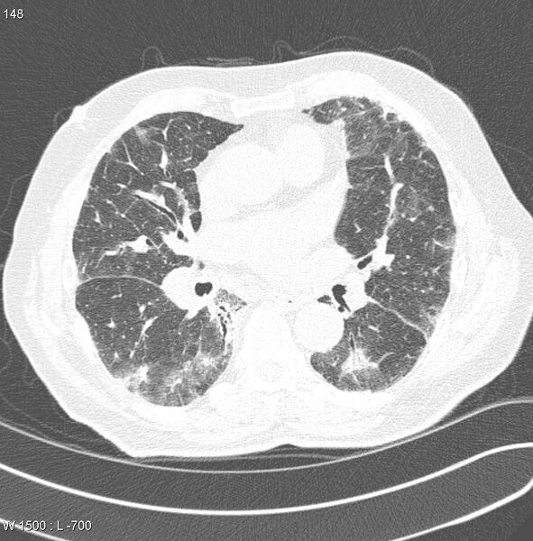 File:Amiodarone lung (Radiopaedia 6539-7851 Axial lung window 15).jpg