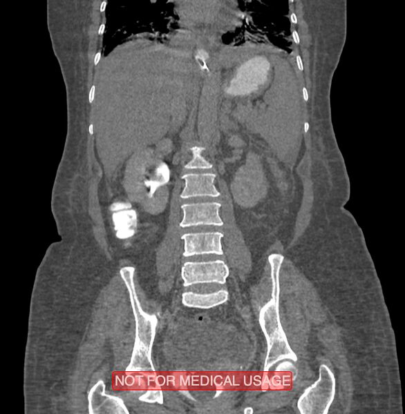 File:Amoebic enterocolitis with liver abscess (Radiopaedia 35100-36609 B 125).jpg