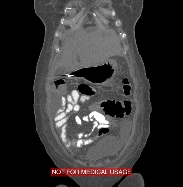 File:Amoebic enterocolitis with liver abscess (Radiopaedia 35100-36609 B 18).jpg