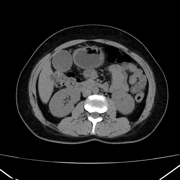 File:Ampullary tumor (Radiopaedia 22787-22816 Axial non-contrast 26).jpg