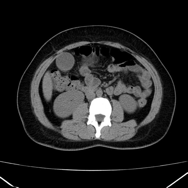 File:Ampullary tumor (Radiopaedia 22787-22816 Axial non-contrast 28).jpg