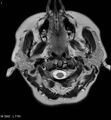 Amyotrophic lateral sclerosis (Radiopaedia 5373-7134 Axial T2 1).jpg