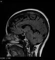 Amyotrophic lateral sclerosis (Radiopaedia 5373-7134 Sagittal FLAIR 14).jpg