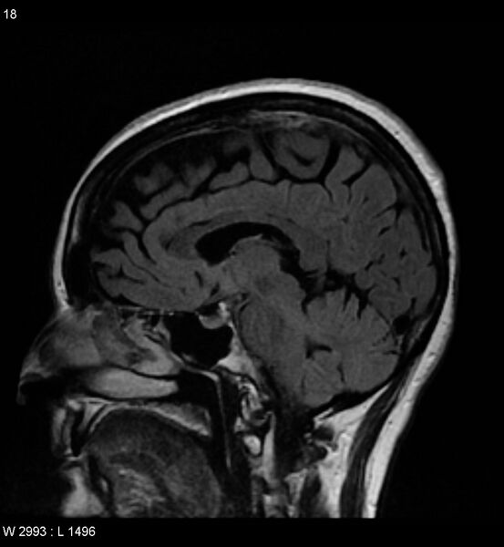 File:Amyotrophic lateral sclerosis (Radiopaedia 5373-7134 Sagittal FLAIR 14).jpg