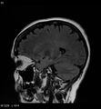 Amyotrophic lateral sclerosis (Radiopaedia 5373-7134 Sagittal FLAIR 19).jpg
