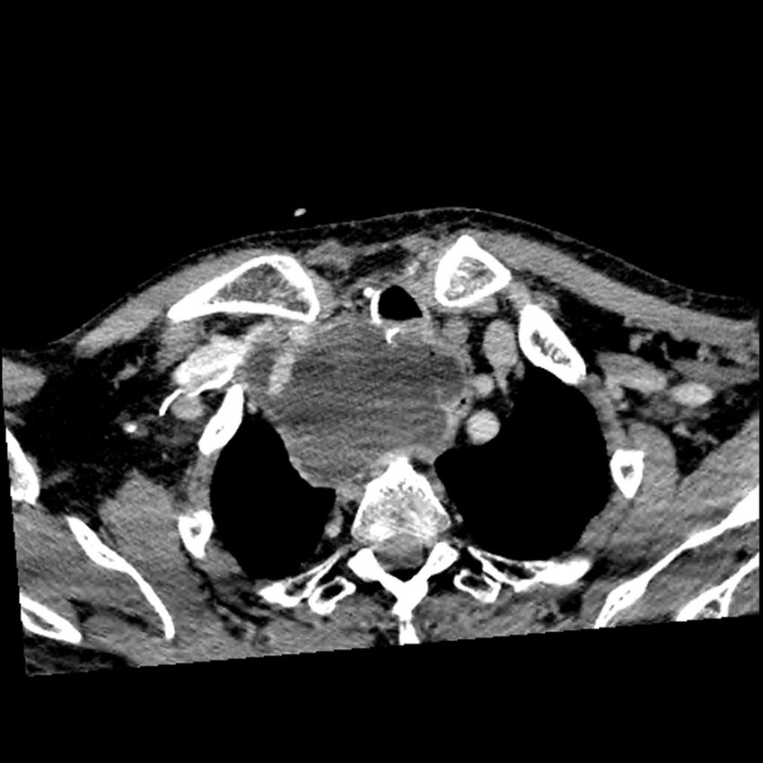Anaplastic thyroid carcinoma (Radiopaedia 79087-92034 B 27).jpg