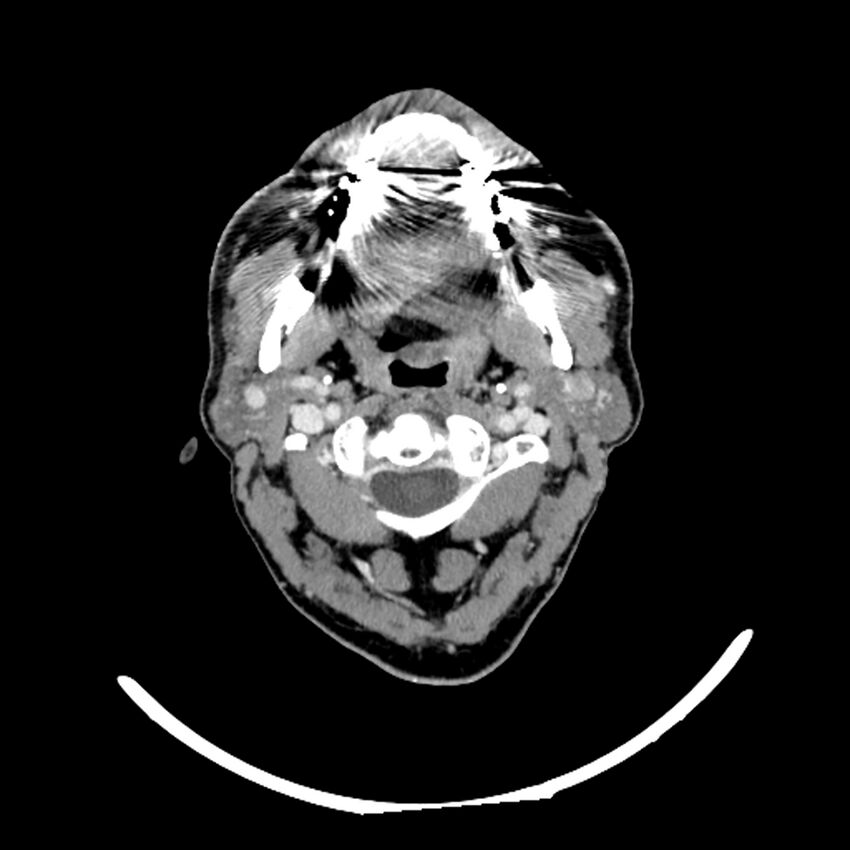 Anaplastic thyroid carcinoma (Radiopaedia 79087-92034 B 98).jpg