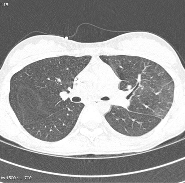 File:Angioinvasive aspergillosis (Radiopaedia 8651-9466 Axial lung window 2).jpg