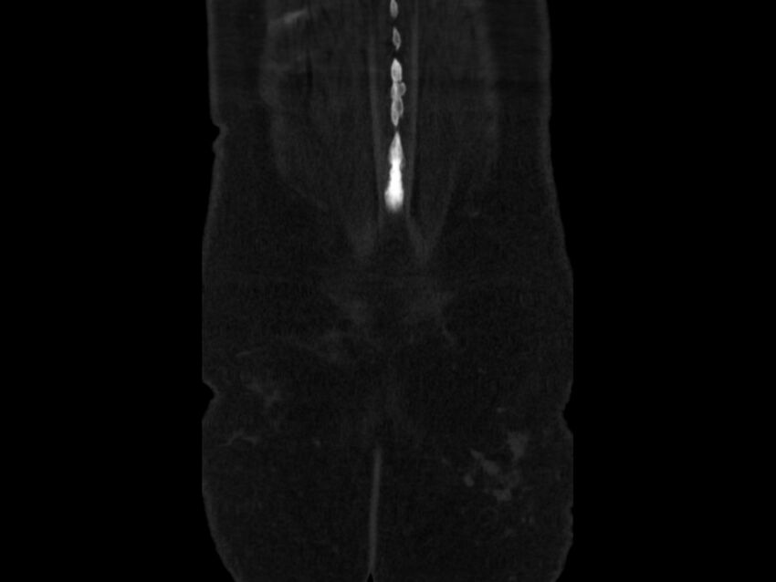 Ankylosing spondylitis (Radiopaedia 44609-48357 Coronal bone window 108).jpg