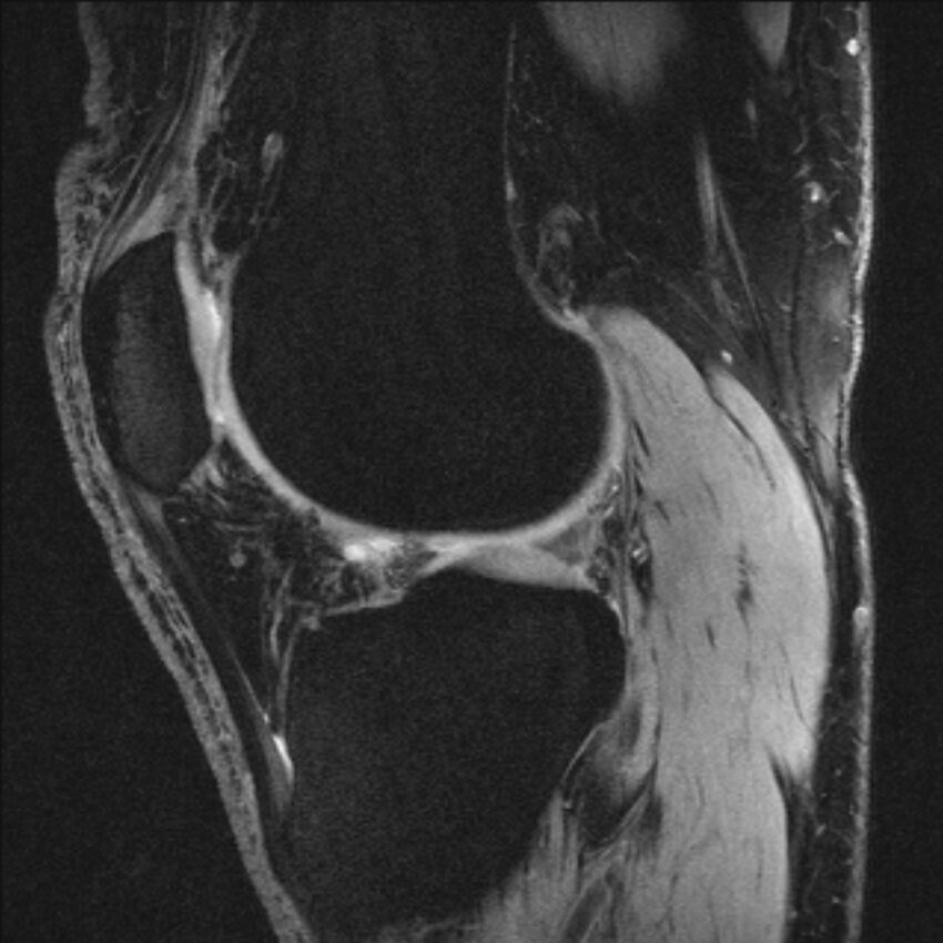 Anterior cruciate ligament mucoid degeneration (Radiopaedia 68400-77933 Sagittal 22).jpg