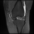 Anterior cruciate ligament tear, Wrisberg rip and bucket-handle tear of medial meniscus (Radiopaedia 75872-87266 Coronal PD fat sat 11).jpg