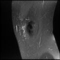 Anterior cruciate ligament tear, Wrisberg rip and bucket-handle tear of medial meniscus (Radiopaedia 75872-87266 Sagittal PD fat sat 25).jpg