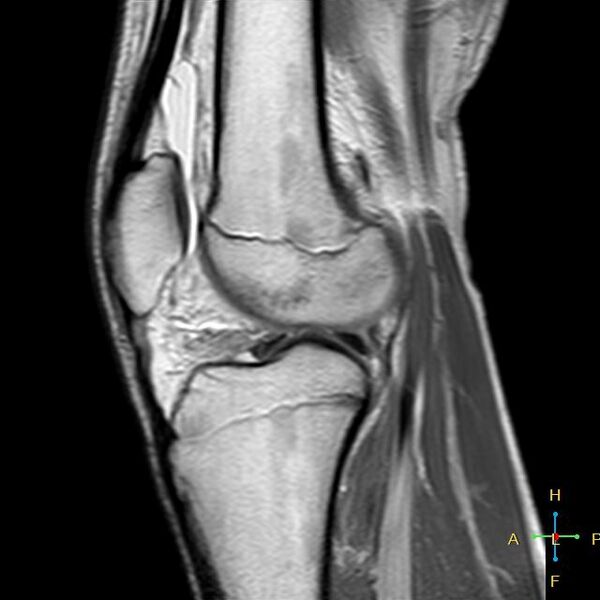 File:Anterior cruciate ligament tear - complete (Radiopaedia 24907-25170 Sagittal PD 7).jpg