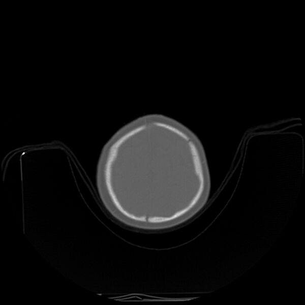 File:Anterior plagiocephaly (Radiopaedia 71836-82273 C 91).jpg