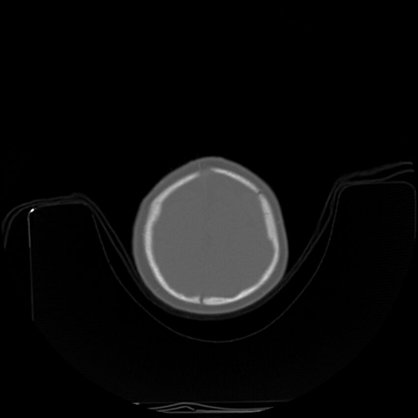 Anterior plagiocephaly (Radiopaedia 71836-82273 C 91).jpg