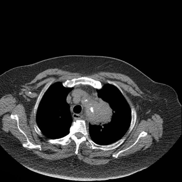 File:Aortic arch false aneurysm (Radiopaedia 14667-14587 Axial non-contrast 4).jpg