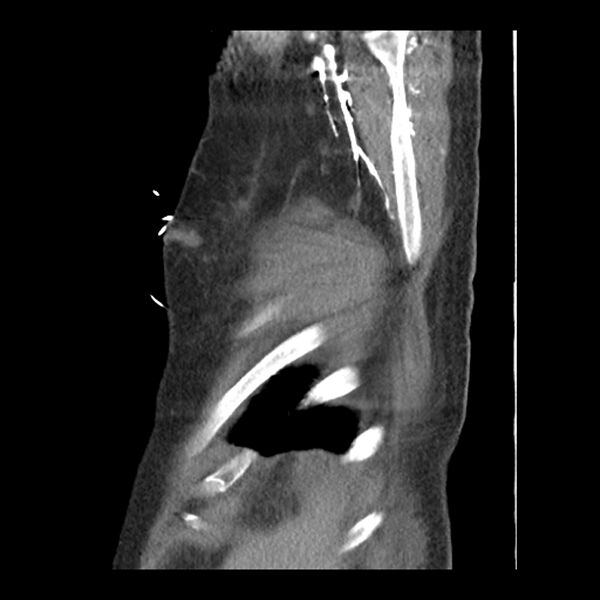 File:Aortic arch graft infection (FDG PET-CT) (Radiopaedia 71975-82437 C 63).jpg