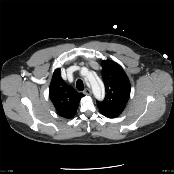 File:Aortic dissection- Stanford A (Radiopaedia 37759-39664 A 7).jpg