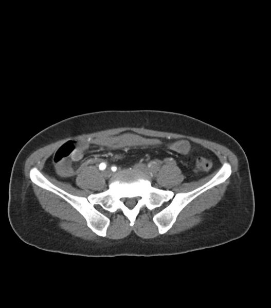 File:Aortic dissection with renal ischemia (Radiopaedia 76573-88338 A 91).jpg