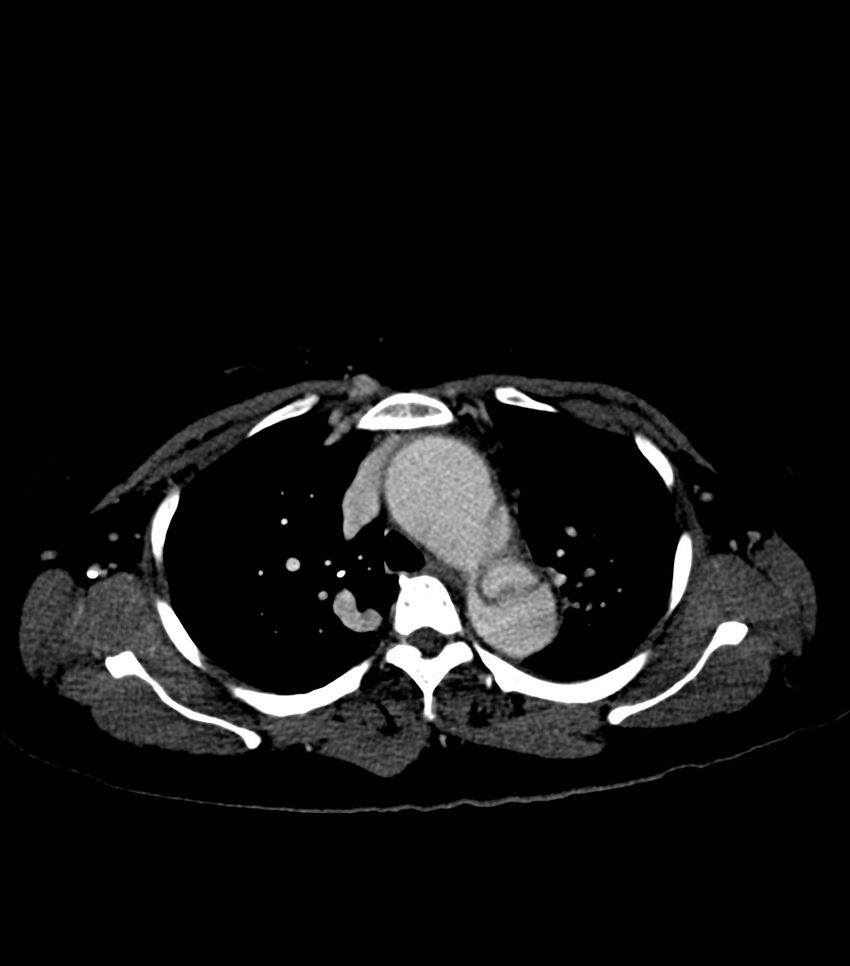 Aortic dissection with renal ischemia (Radiopaedia 76573-88338 B 10).jpg