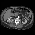 Aortic dissection with rupture into pericardium (Radiopaedia 12384-12647 A 62).jpg