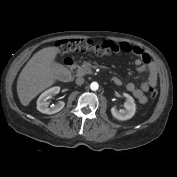 File:Aortic dissection with rupture into pericardium (Radiopaedia 12384-12647 A 62).jpg