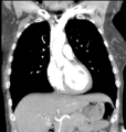 Aortic valve non-coronary cusp thrombus (Radiopaedia 55661-62189 C 31).png