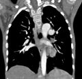 Aortopulmonary window, interrupted aortic arch and large PDA giving the descending aorta (Radiopaedia 35573-37074 D 44).jpg