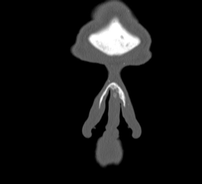 File:Aplastic maxillary sinuses (Radiopaedia 60030-67561 Coronal non-contrast 1).jpg