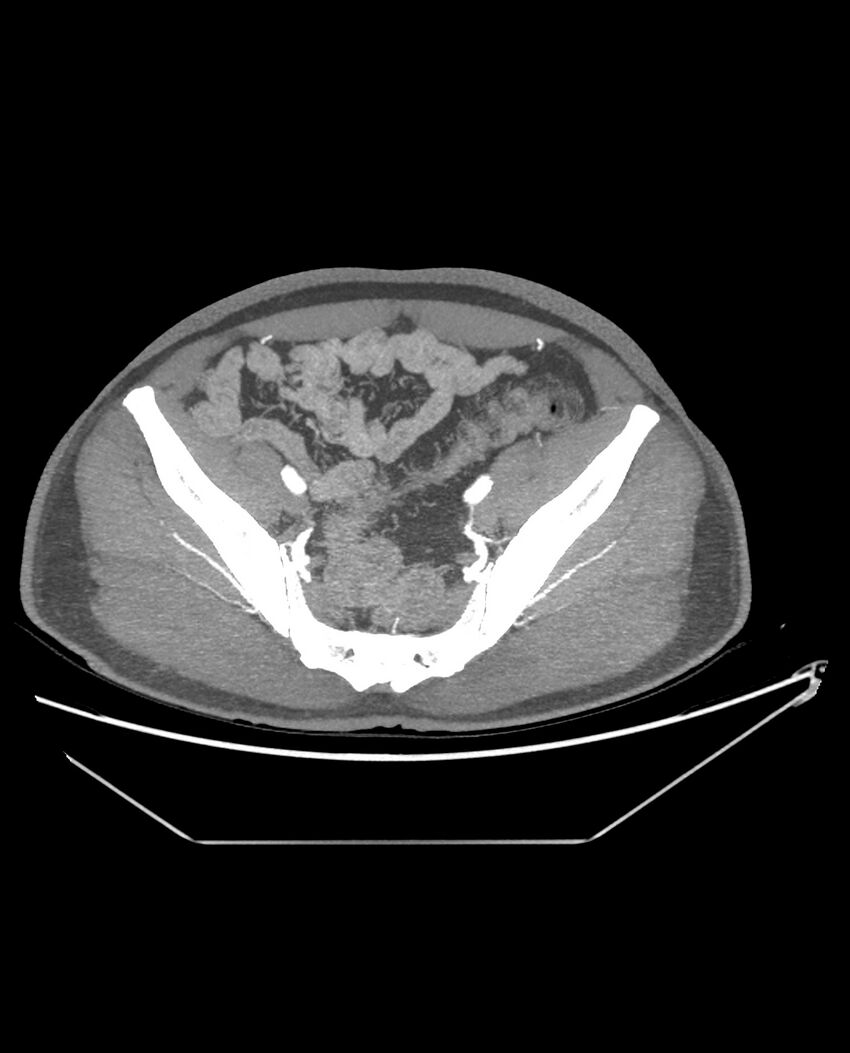 Aplastic posterior tibial arteries (Radiopaedia 84021-99249 A 87).jpg