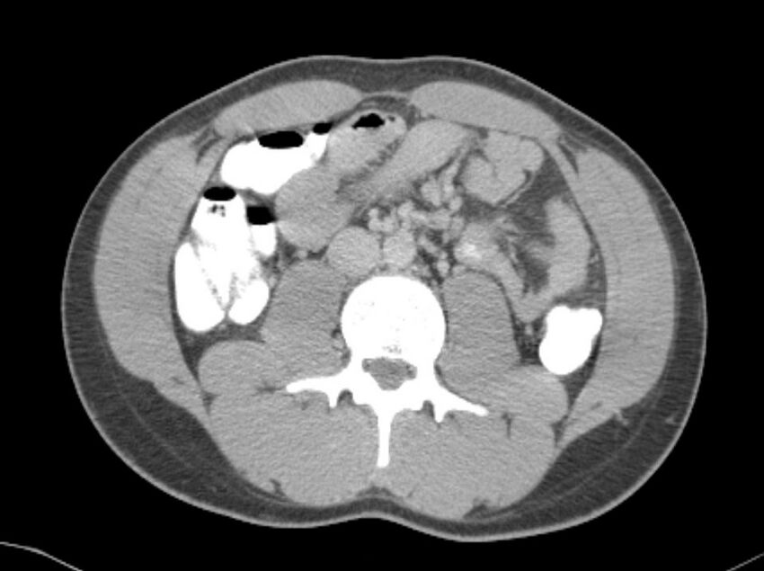 Appendicitis and incidental foregut duplication cyst (Radiopaedia 52962-58916 A 35).jpg