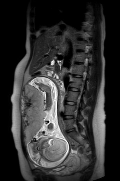 File:Appendicitis in gravida (MRI) (Radiopaedia 89433-106395 Sagittal T2 36).jpg