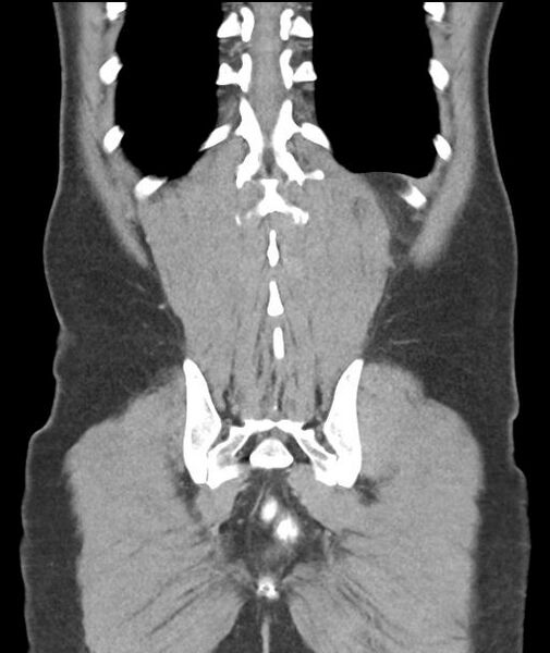 File:Appendicitis with cecal bar sign (Radiopaedia 31878-32830 A 51).jpg