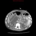 Appendicitis with phlegmon (Radiopaedia 9358-10046 A 33).jpg