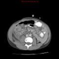 Appendicitis with phlegmon (Radiopaedia 9358-10046 A 40).jpg
